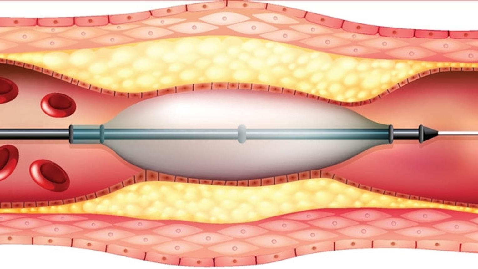 Drug-Coated Balloons Could Offer an Alternative to Permanent Heart Stents