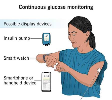 Continuous Glucose Monitors May Help Type 2 Diabetes Patients Who Do Not Use Insulin