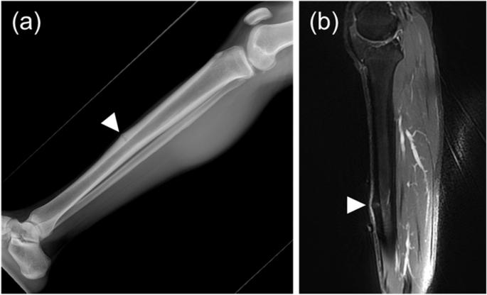 Ultrasonic Technology May Help Detect Stress Fractures Earlier
